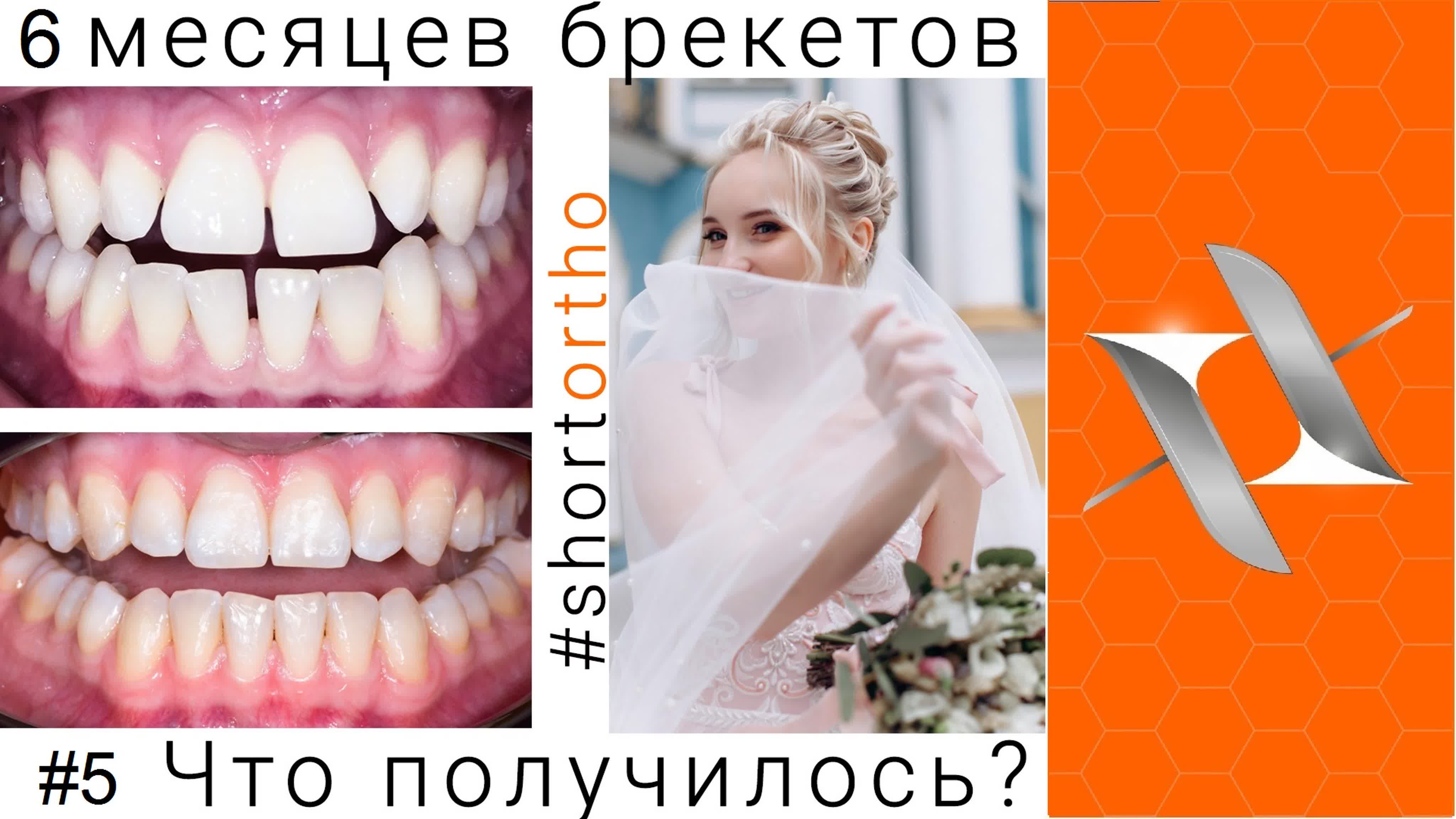 #Shortortho брекеты к свадьбе за 6 месяцев