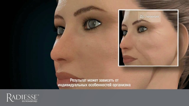 Radiesse™ (Радиес)
