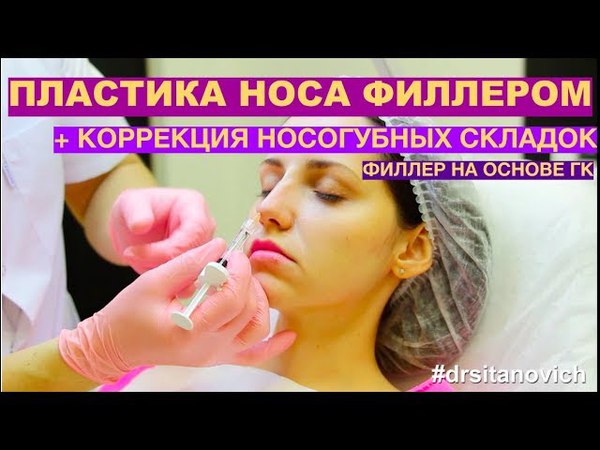 Моделирование носа филерами