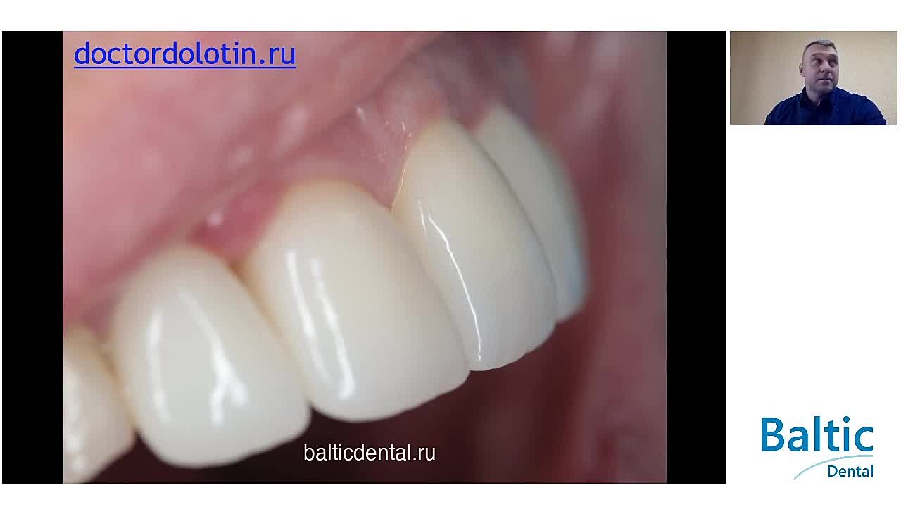 Имплантация