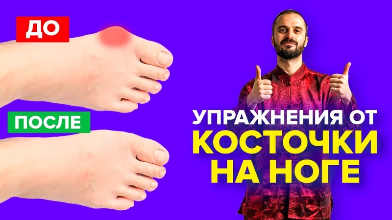 косточка на ноге