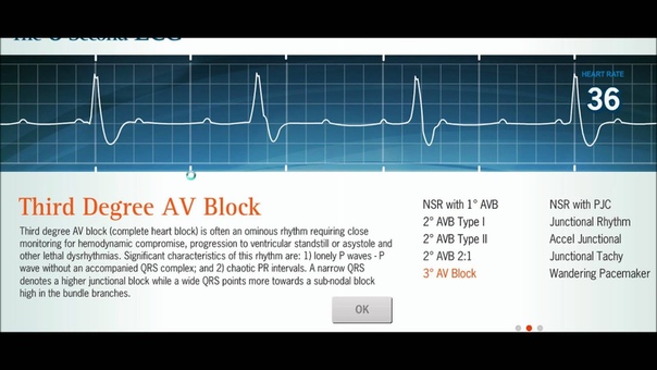 EKG